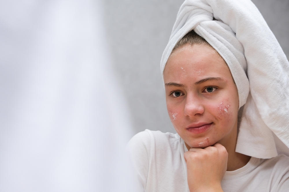 CBD per l'acne: una soluzione naturale per una pelle pulita